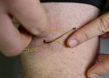 Video: How to Remove a Fish Hook from Human Skin